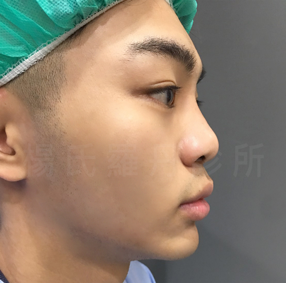  縮唇 厚唇 挺鼻 醫學美容 楊氏羅丹